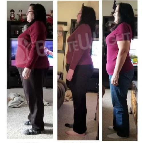 Gastric Sleeve